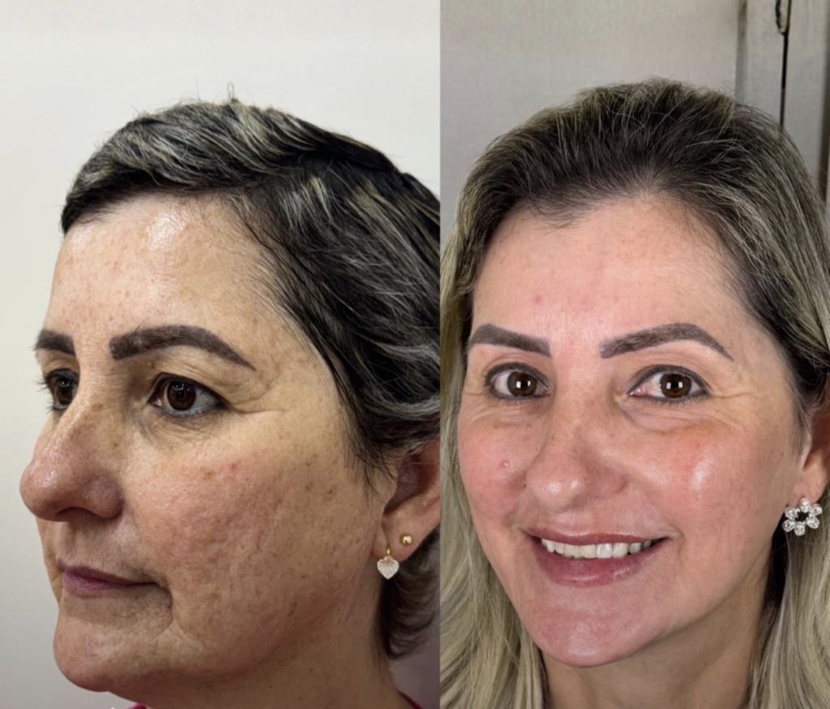 Comparativo de antes e depois de paciente atendida na RADA CLINIC
