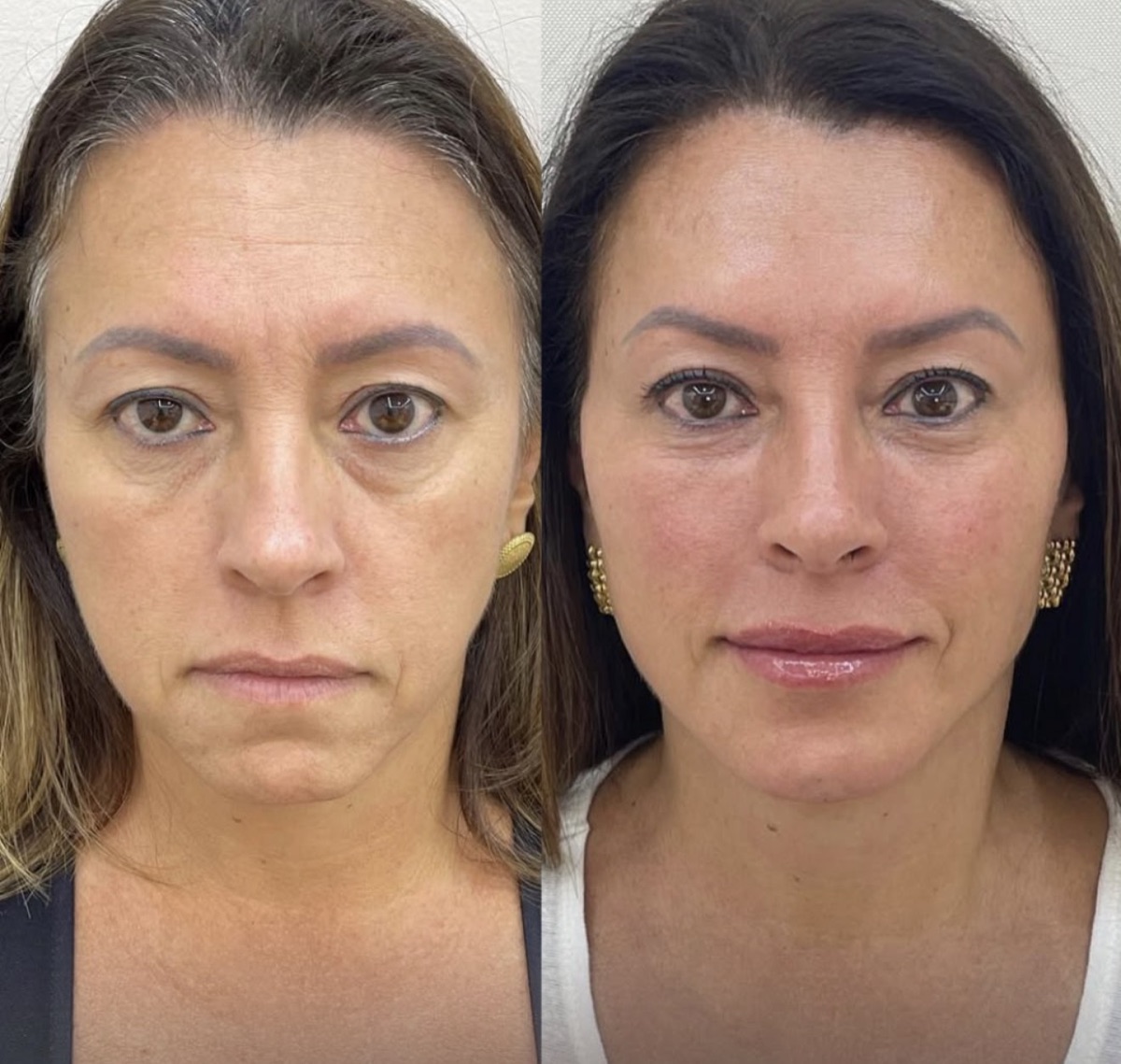 Comparativo de antes e depois de paciente atendida na RADA CLINIC