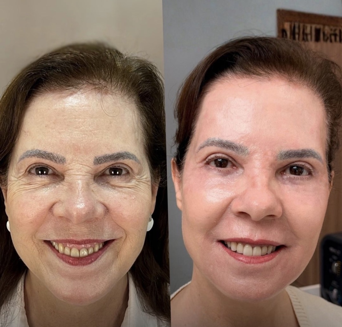 Comparativo de antes e depois de paciente atendida na RADA CLINIC